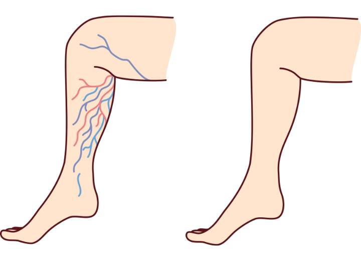 下肢静脈瘤とは