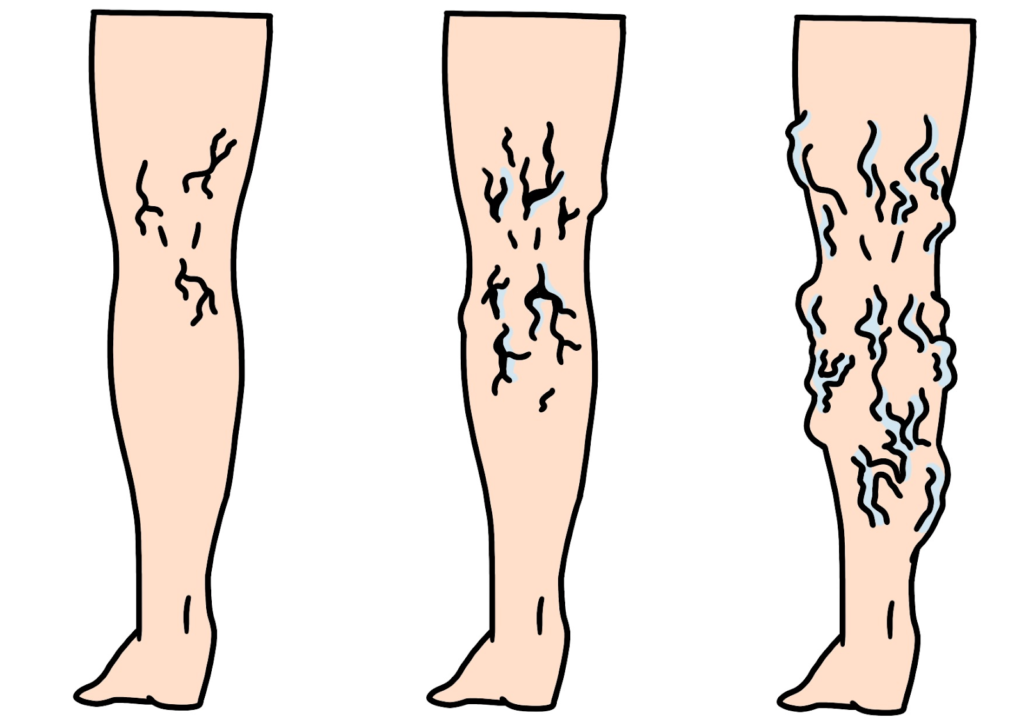 足の血管が浮き出るのは下肢静脈瘤？