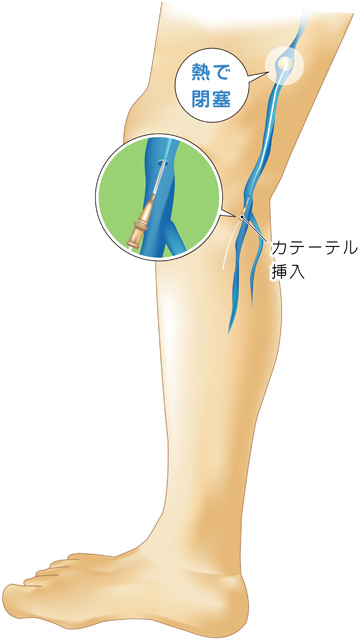 レーザー治療（血管内焼灼術）について